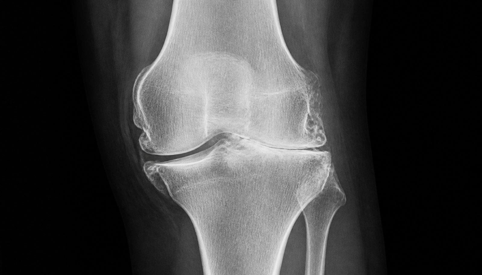 Knee X-ray showing collapsed joint space